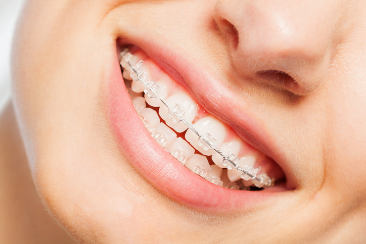 Orthodontic Treatment (Braces / Clear Aligners)
